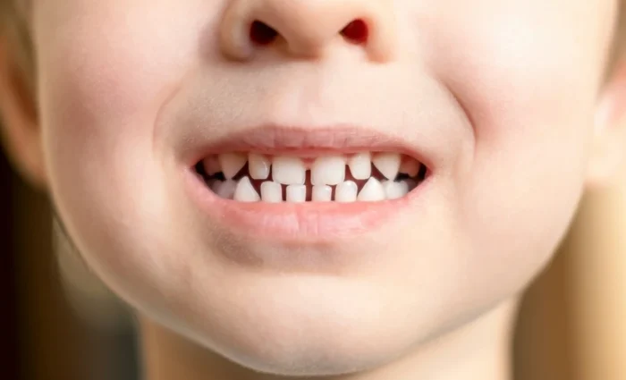 Correzione dello spazio fra i denti