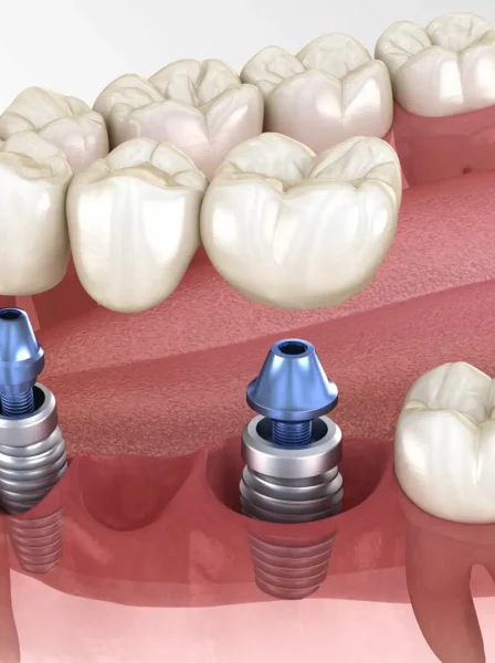 Ponte-su-impianti-dentali