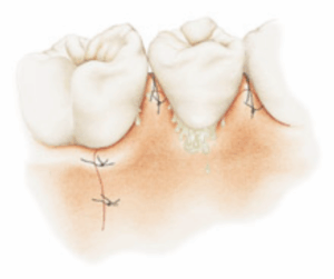 La terapia chirurgica della parodontite